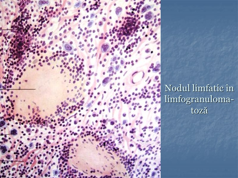 Nodul limfatic în limfogranuloma-toză